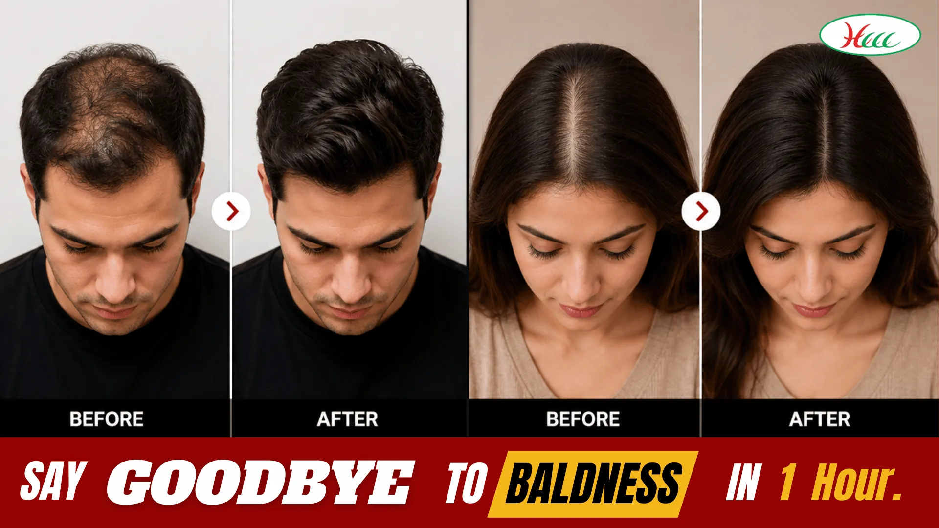 Hair Replacement Before After Results for Men and Women - Say Goodbye to Baldness in 1 Hour at HCCC Coimbatore